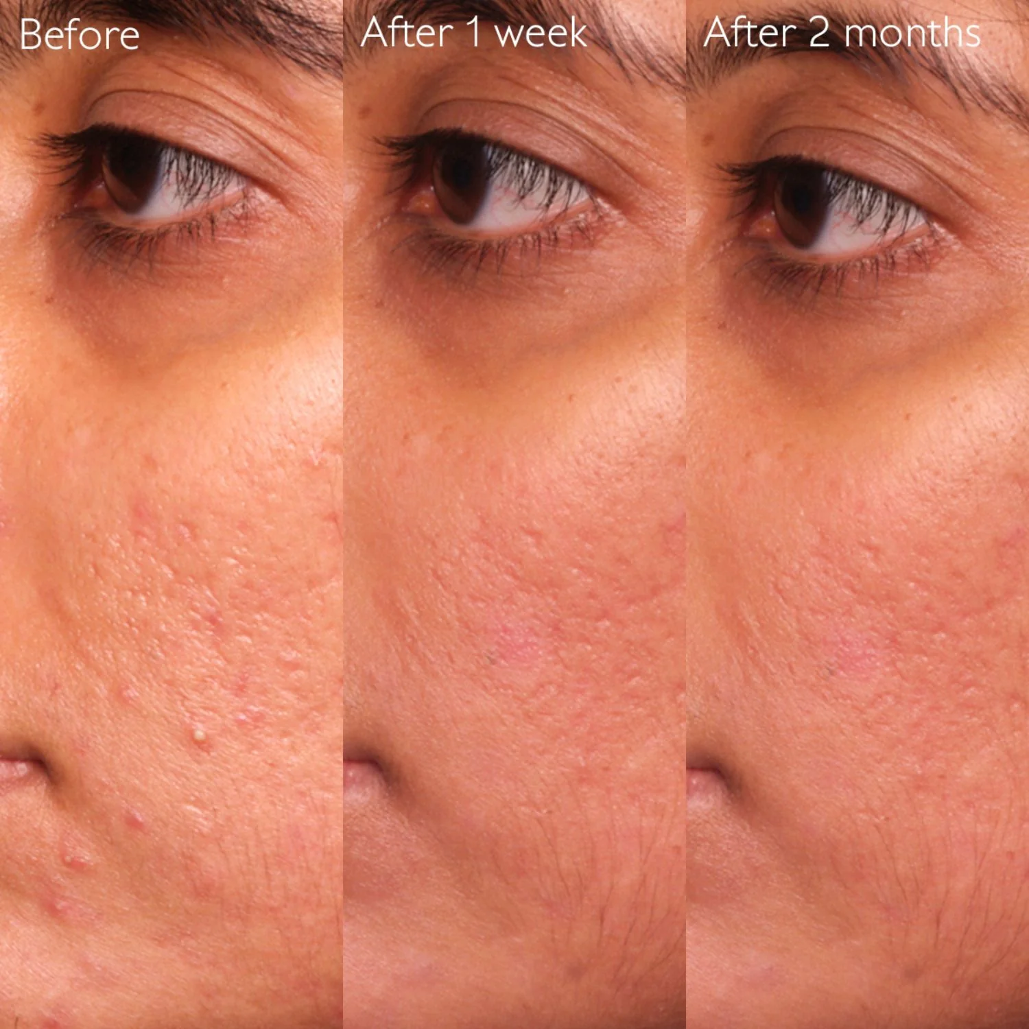Caudalie | Vinopure Blemish Control Salicylic Serum 30ml - Image 4