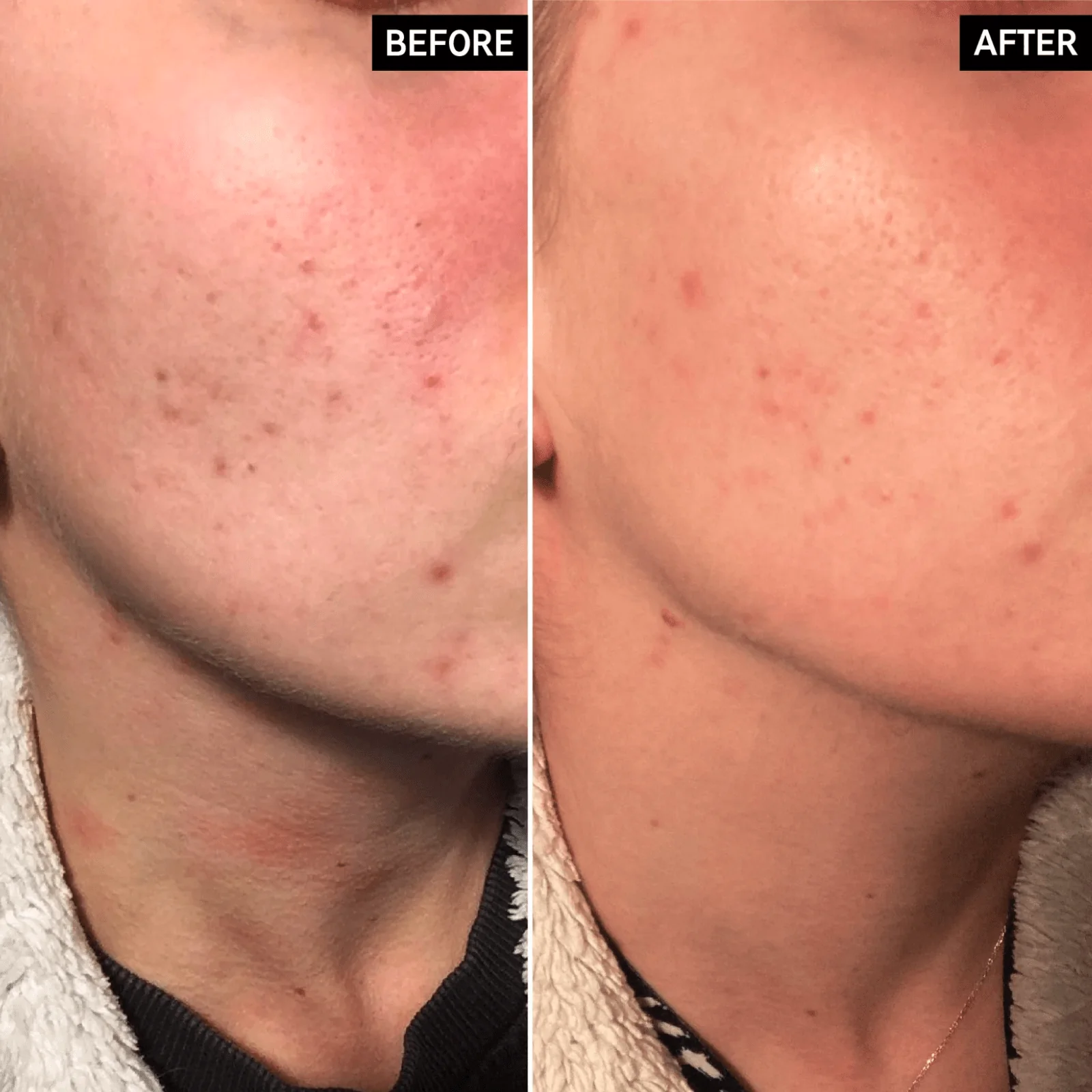 The Inkey List | Apple Cider Vinegar Acid Peel 30ml - Image 7