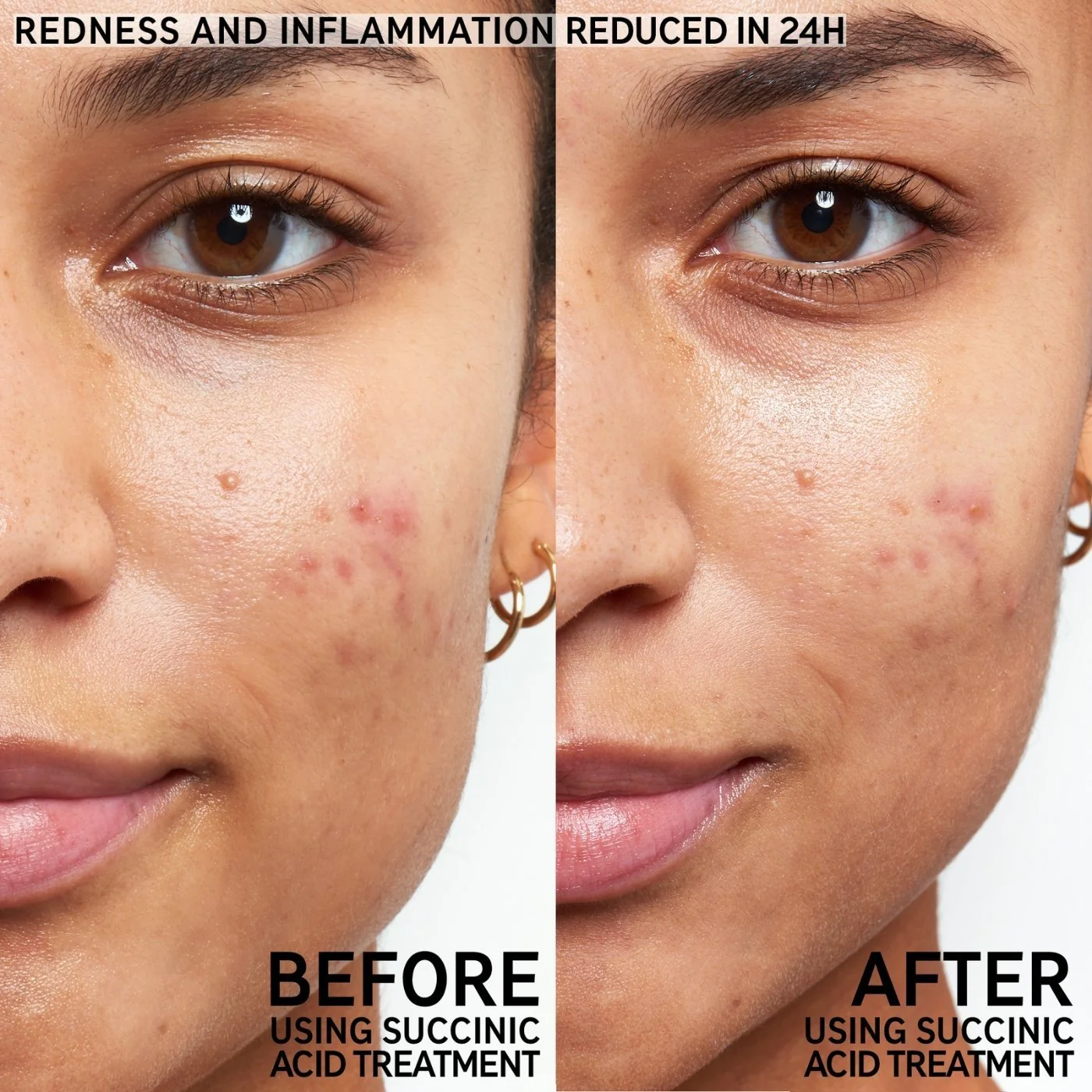 The Inkey List | Succinic Acid Blemish Treatment 15ml - Image 5